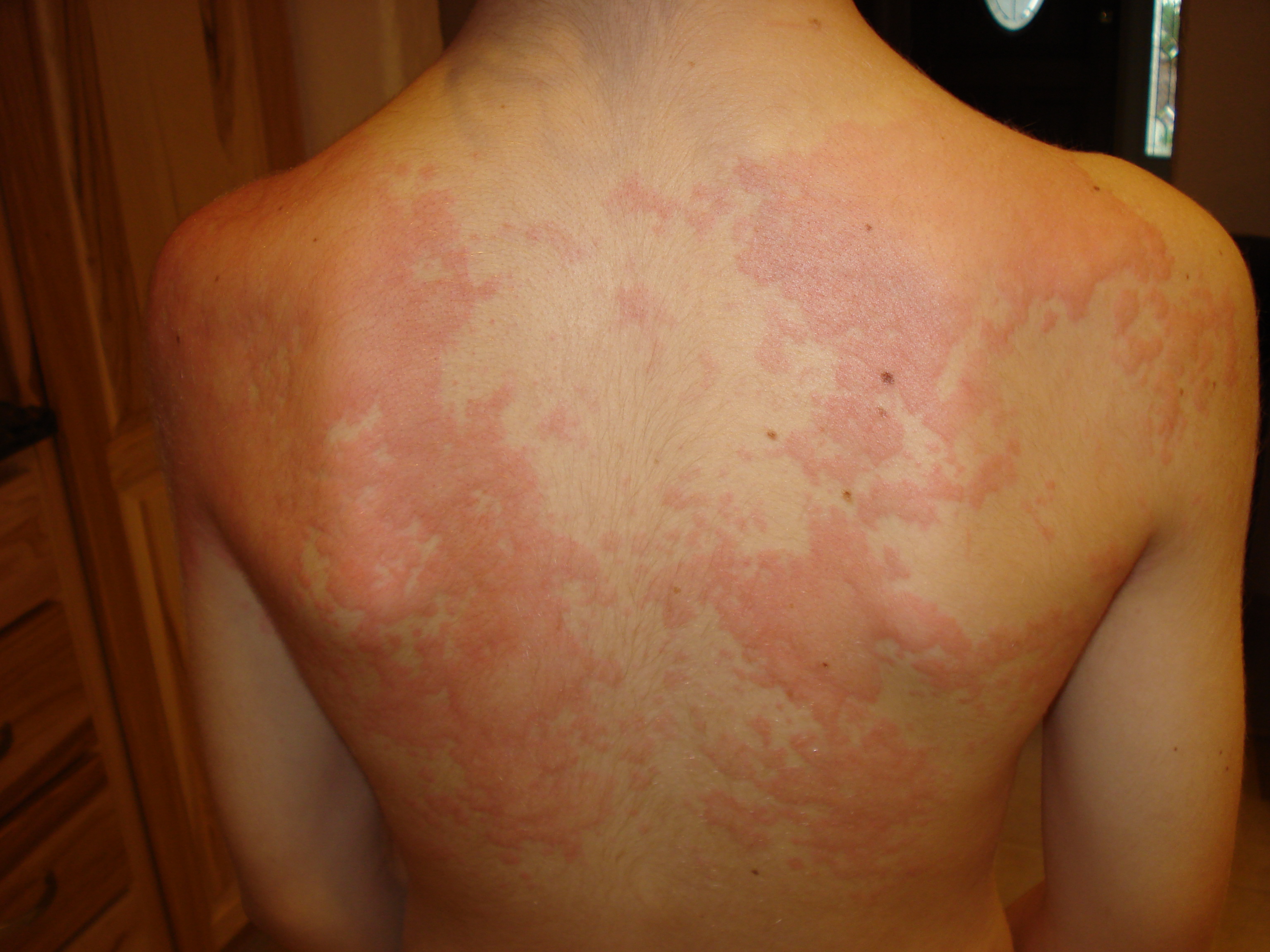 Picture of Hives (urticaria) - WebMD